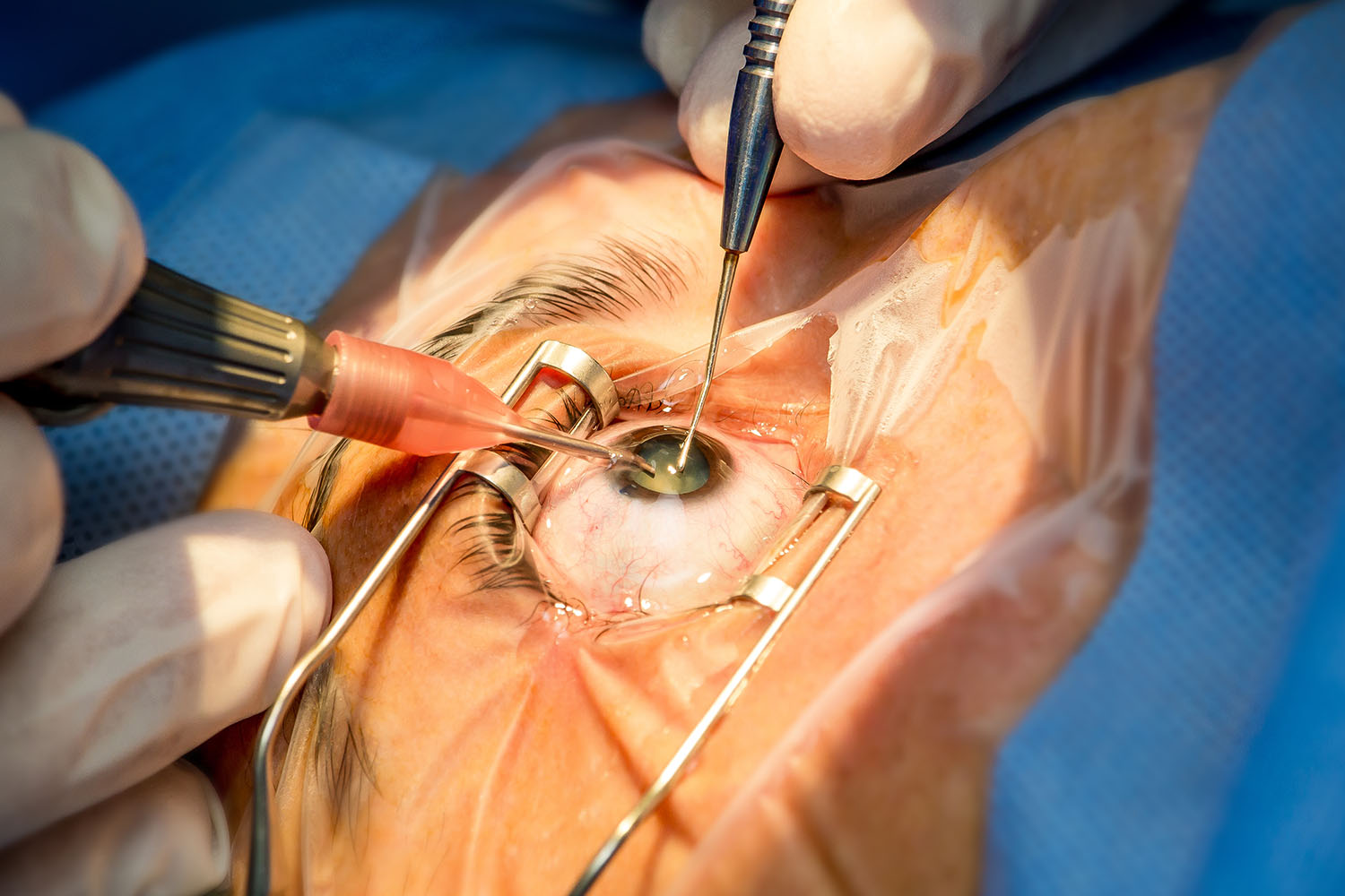 Cataract Care – Cataract Surgery