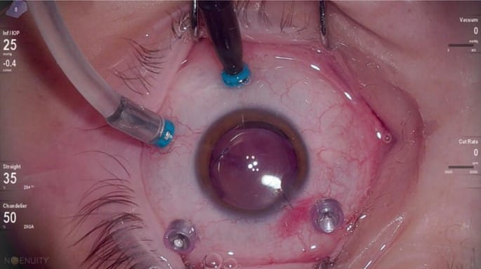 Retina Care – Vitreo Retina Surgery